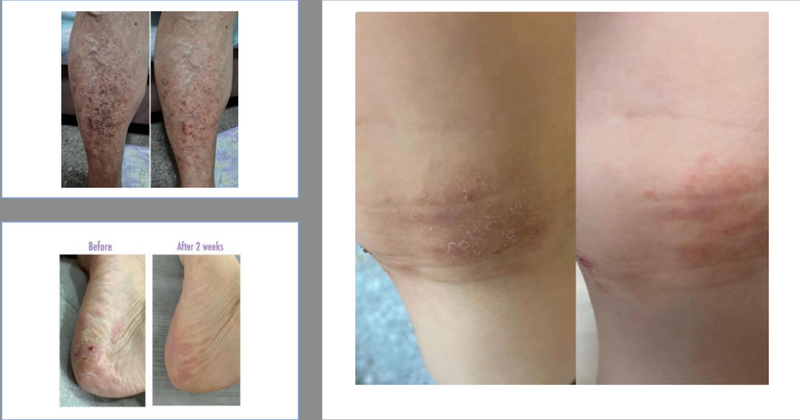 Before-After Use of Elemois Body Gel